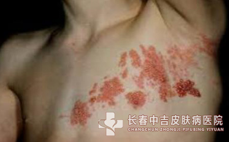 患有带状疱疹该怎么吃