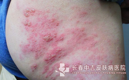 带状疱疹患者需要注意什么