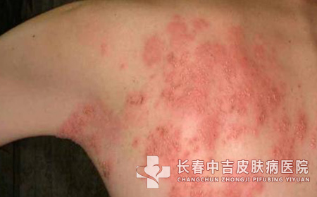 带状疱疹护理的注意事项有哪些