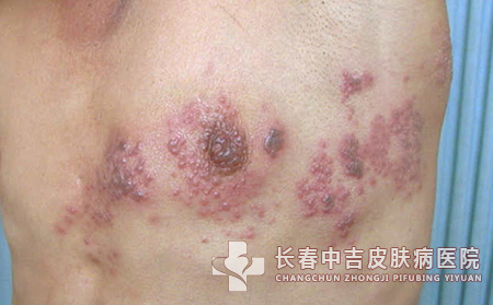 带状疱疹患者的饮食注意