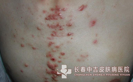 瘢痕
