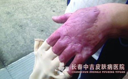 瘢痕
