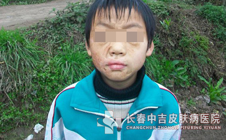 瘢痕