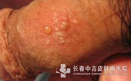 性病的种类与图片