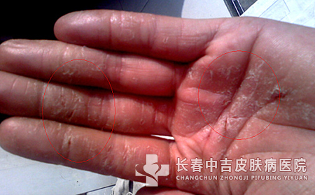 手癣的临床症状