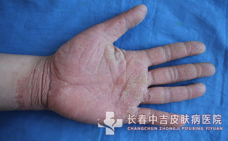 手癣的治疗方法