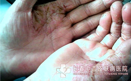 手癣的并发症