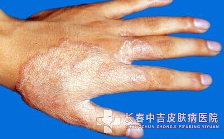 手癣的严重程度分类