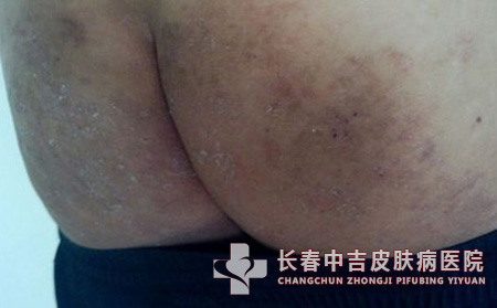 股癣症状