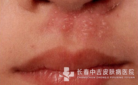 单纯疱疹