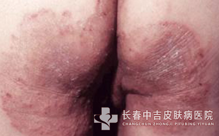 股癣治疗