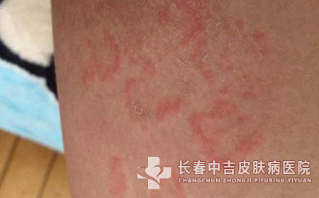 股癣治疗