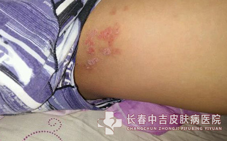 股癣治疗