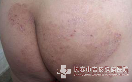 股癣预防