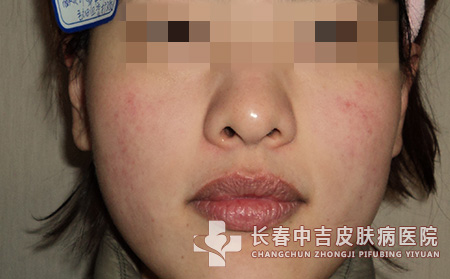 脸上红血丝怎么形成的