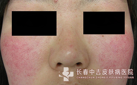 面部红血丝的原因是什么