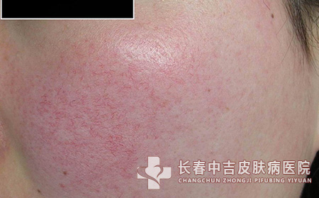 红血丝怎么消除小其他方
