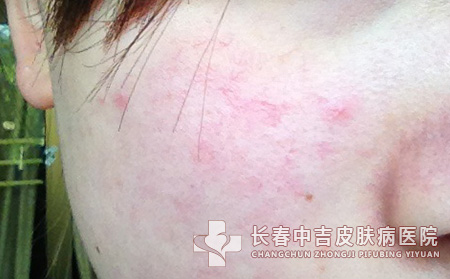 女生脸上红血丝合适治不错吗
