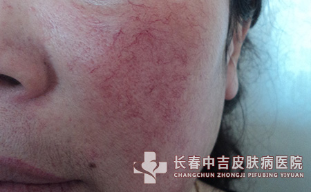 红血丝的饮食应注意哪些