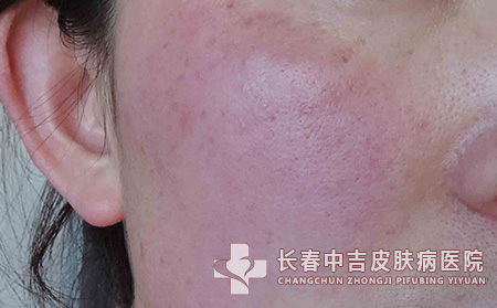 吃什么合适改善红血丝