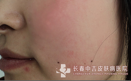 脸上有红血丝怎么办?合适饮食和习惯来帮忙去除