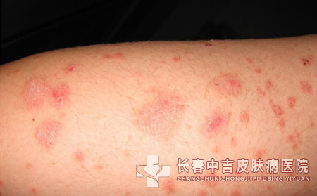 接触性皮炎的早期的特点