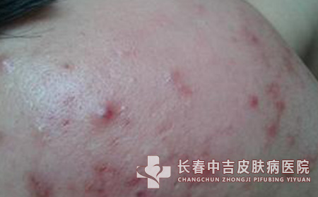 痤疮患者饮食的宜与忌