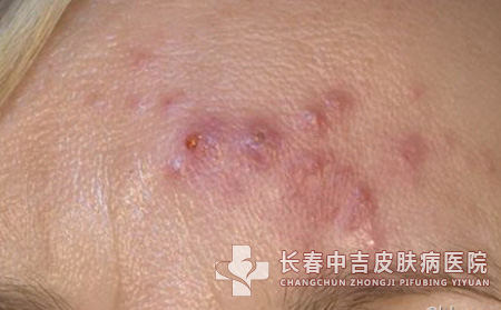 中医治疗痤疮