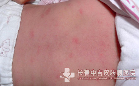 得了接触性皮炎要怎么处理合适