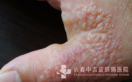 皮肤接触性皮炎怎么办