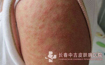 患了接触性皮炎的治疗