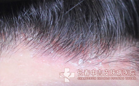 毛囊炎,毛囊炎症状,长春中吉皮肤病医院