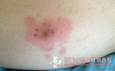 吃芒果小心“芒果皮炎”