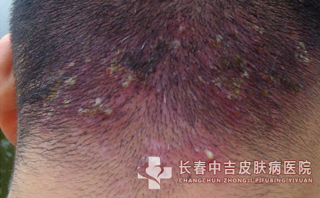 毛囊炎,毛囊炎病因,长春中吉皮肤病医院
