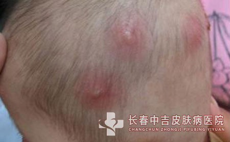 毛囊炎,毛囊炎病因,长春中吉皮肤病医院