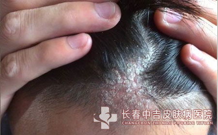 毛囊炎治疗,长春中吉皮肤病医院