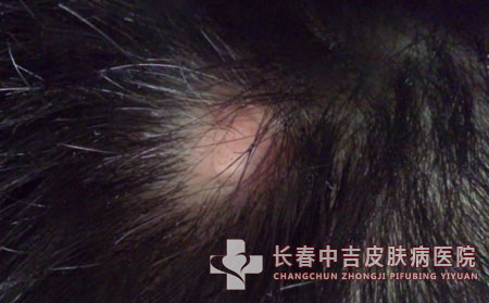 毛囊炎,毛囊炎治疗,长春中吉皮肤病医院