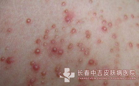 毛囊炎,毛囊炎治疗,长春中吉皮肤病医院