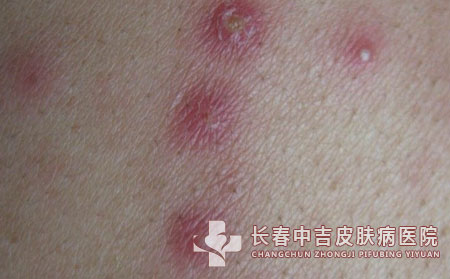 毛囊炎,毛囊炎治疗,长春中吉皮肤病医院
