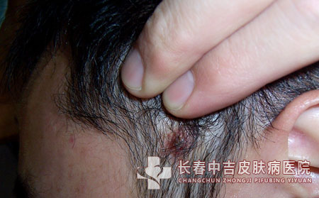 毛囊炎,毛囊炎预防,长春中吉皮肤病医院