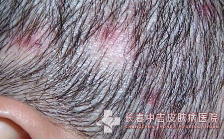 毛囊炎,毛囊炎预防,长春中吉皮肤病医院