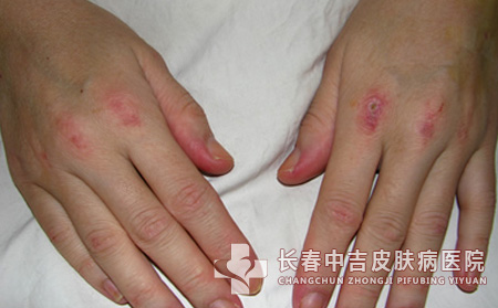 皮肌炎症状,皮肌炎患者,长春中吉皮肤病医院