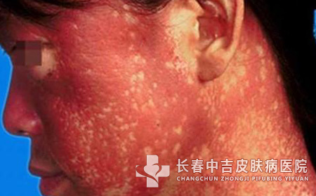 皮肌炎的治疗方法到底怎么样?