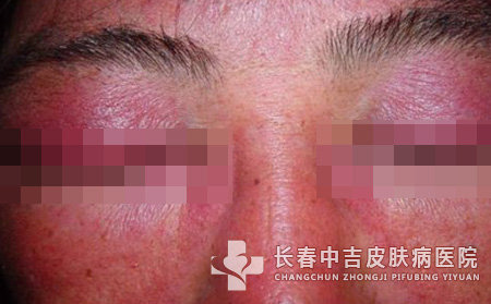 皮肌炎,治疗药物,长春中吉皮肤病医院
