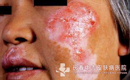 皮肌炎,治疗药物,长春中吉皮肤病医院
