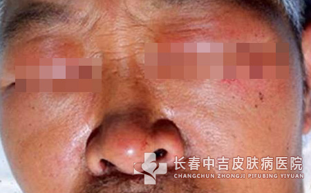 皮肌炎症状,皮肌炎患者,长春中吉皮肤病医院