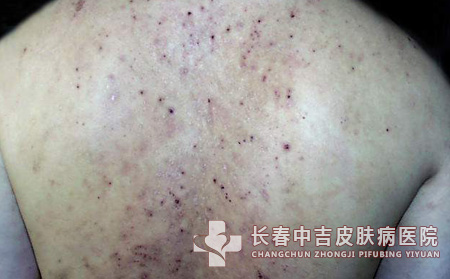 皮肌炎,治疗药物,长春中吉皮肤病医院