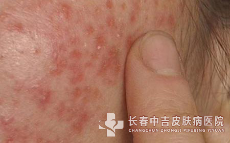 皮炎,皮炎症状,长春中吉皮肤病医院