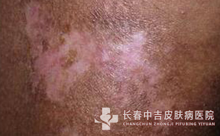 皮肌炎,治疗药物,长春中吉皮肤病医院