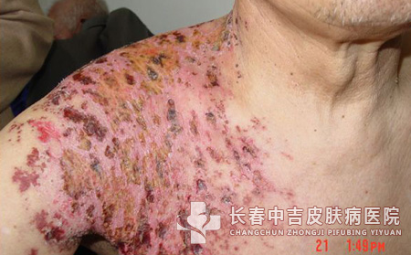 预防皮肌炎的重要措施